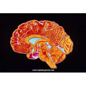  Coloured CT scan of a healthy brain (side view 