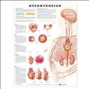  Hypertension Anatomical Chart 20 X 26 Health & Personal 